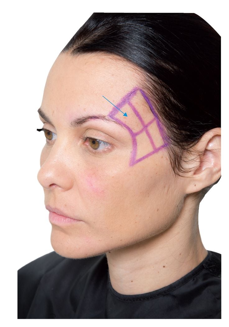 Dermal Filler level 2