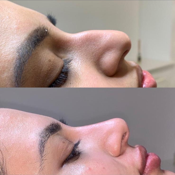 Non-Surgical Rhinoplasty
