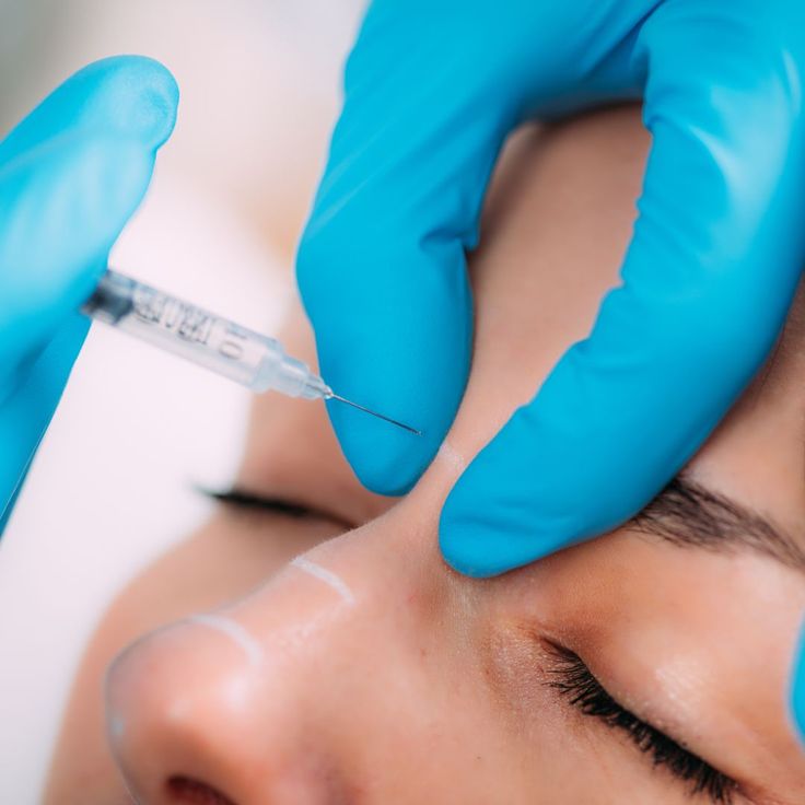 dermal filler Rhinoplasty (Hybrid)