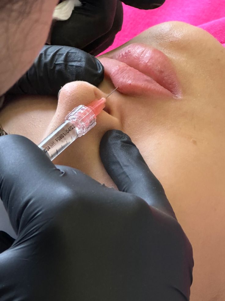 dermal filler russian lips (Hands-On)